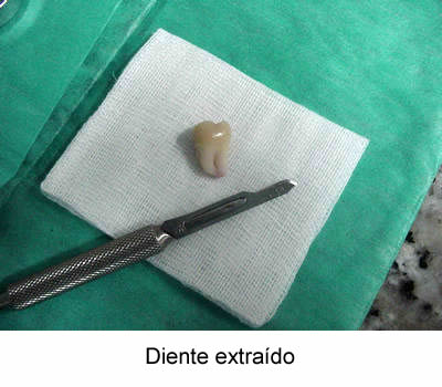 las muelas del juicio: diente extraído
