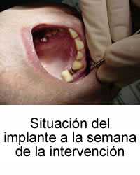 Situación del implante a la semana de la intervención