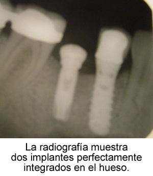 la radiografía muestra dos implantes perfectamente integrados en el hueso