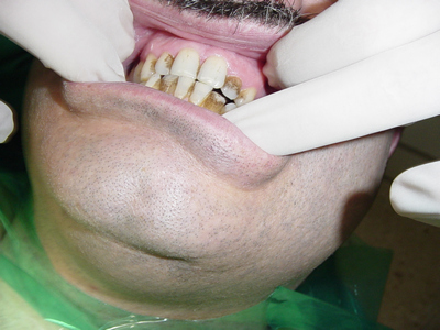 limpieza dental: sarro 01