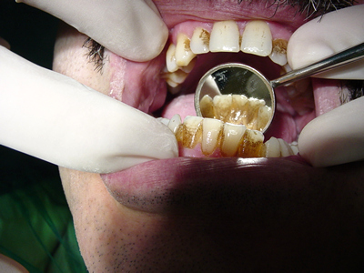 limpieza dental: sarro 02