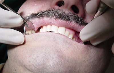 limpieza dental: sarro 03
