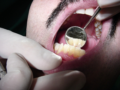 limpieza dental: sarro 04