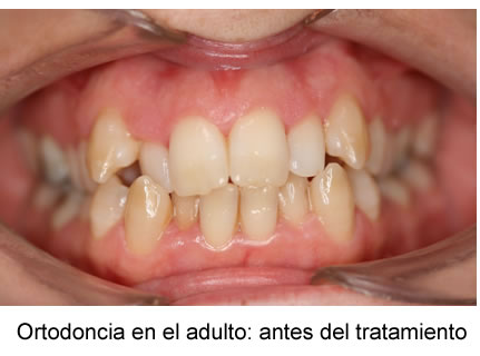 ortodoncia en el adulto: antes del tratamiento