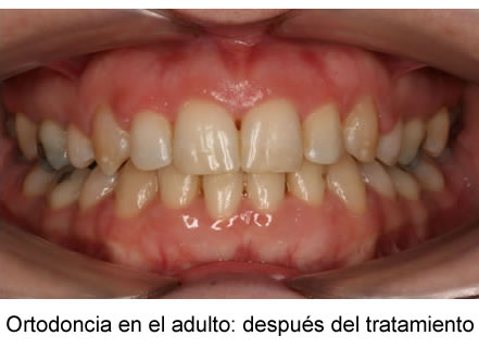 ortodoncia en el adulto: después del tratamiento