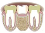 reposición de los espacios dejados por un diente extraído 02